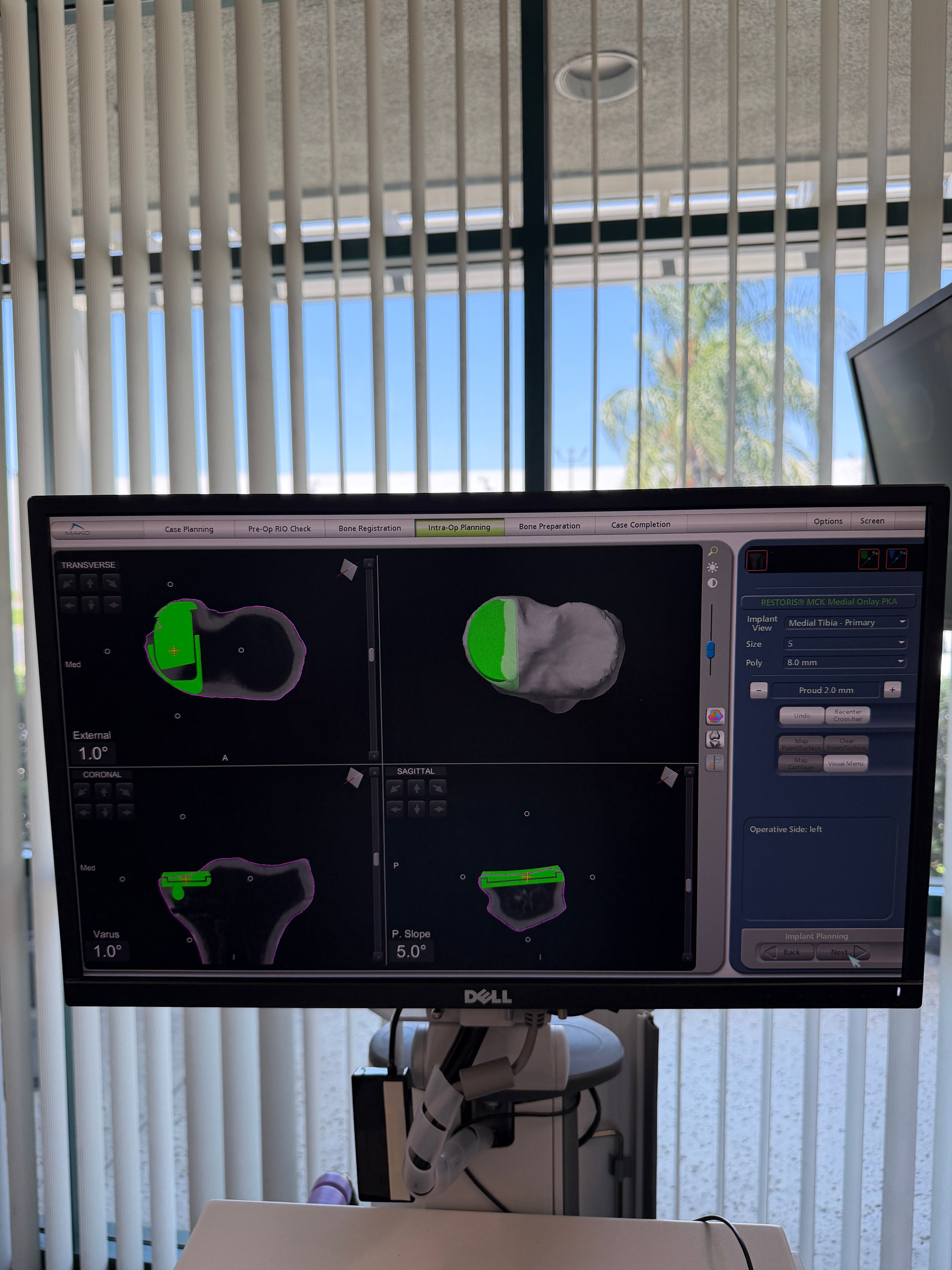 Stryker Mako Complete Program Bundle | Robot + TKA, THA & PKA Instrument Sets